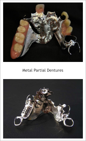 metal partial dentures